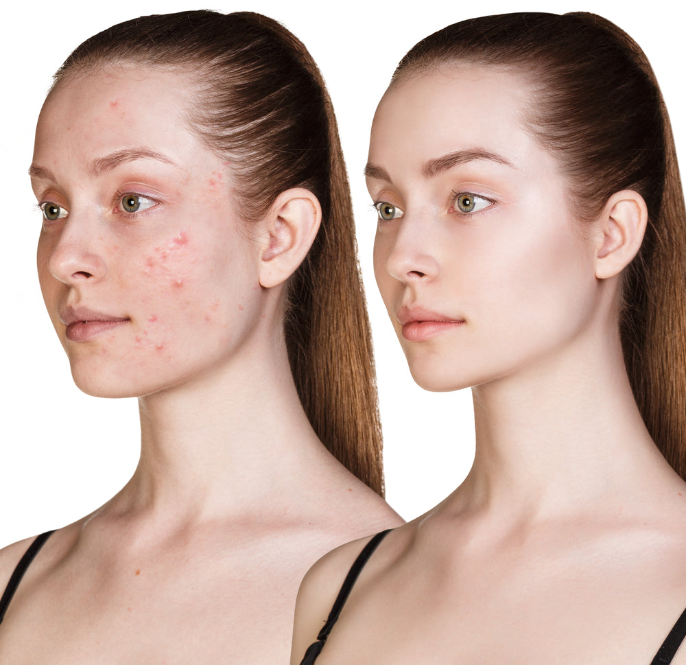 How Can I Keep Acne Breakouts from Happening?
